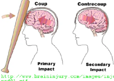 Gambar 5.  Cedera Countre-Coup (Dikutip dari: http://ffden-