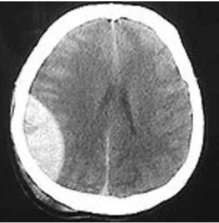 Gambar 6.  CT Scan Hematom Epidural. (Dikutip dari: 
