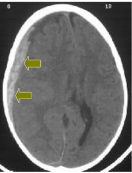 Gambar 7.  CT Scan Hematom Subdural. (Dikutip dari: 