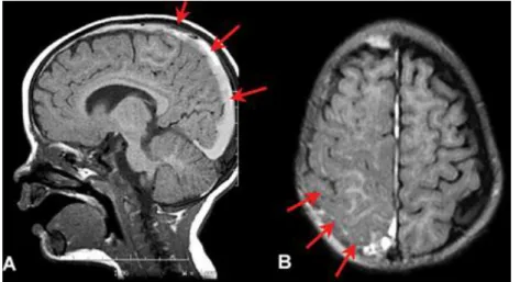 Gambar 11.  CT Scan Subarachnoid Hemorrhage (Dikutip dari: 