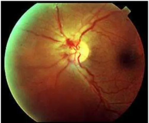 Gambar 2.8  Perdarahan pada retinopati diabetik nonproliferatif 