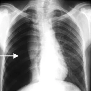 Gambar 3. foto Pneumothorax dengan bayangan udara dalam cavum pleura memberikan  bayangan radiolusen yang tanpa struktur jaringan paru (avascular pattern) (11).