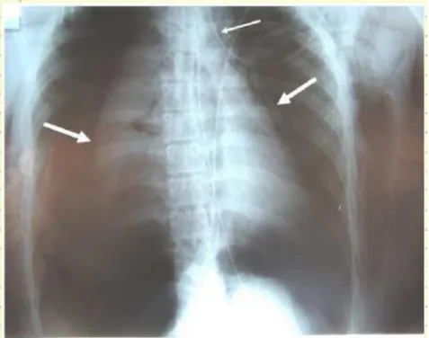 Gambar 6. Pneumothorax bilateral pada arah panah tebal dan pneumomediastinum pada  arah panah yang tipis (11).