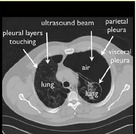 Gambar 8. Pneumothorax potongan axial tampak udara dan terjadinya colaps paru  (12).