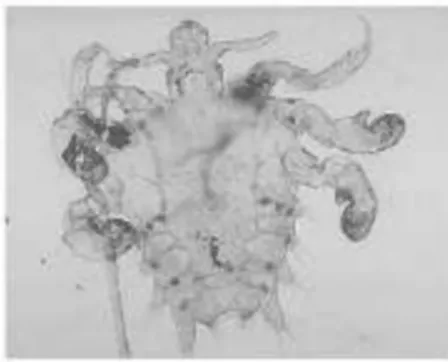 Gambar 4: Phthirus pubis (crab louse)