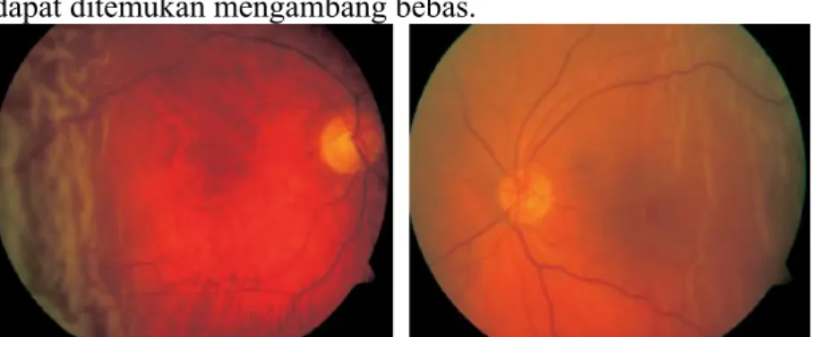 Gambar 2.5  Gambaran pemeriksaan funduskopi pada pasien eksudatif  ablasio retina