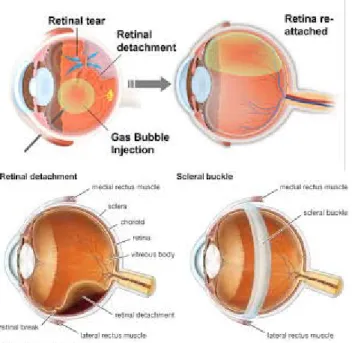 Gambar 2.6. penanganan ablasio retina 2.8. Prognosis