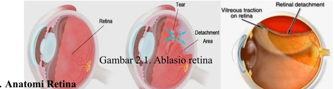 Gambar 2.1. Ablasio retina 2.2. Anatomi Retina