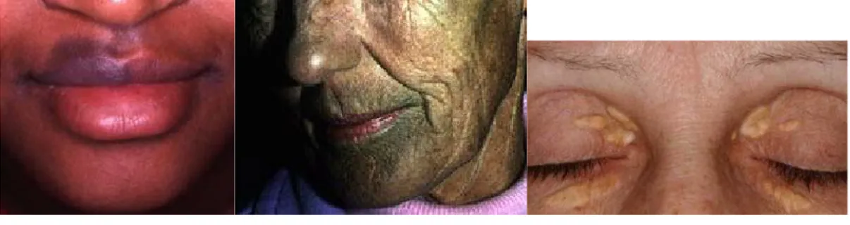 Gambar 5. Kiri dan tengah : pasien dengan hiperpigmentasi akibat obat, kanan : xanthelasma  pada pasien dislipidemia 