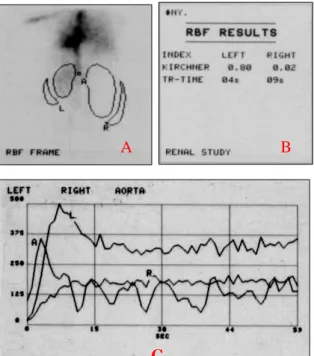 Gambar  4.2A  memperlihatkan  proses  penyerapan  radiofarmaka  pada  ginjal.  Ginjal  kanan  (R)  terlihat  lebih  besar dibandingkan ginjal kiri (L), bagian  dalam  ginjal  kiri  terlihat  berwarna  gelap 