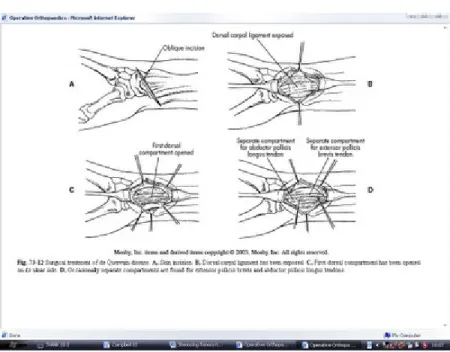 Gambar 12. Teknik operasi pada de Quervain’s Syndrome (dikutip dari kepustakaan nomor 18)