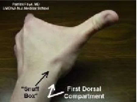 Gambar 1. Kompartemen dorsal pertama pergelangan tangan pada daerah tepi  lateral dari snuffbox.