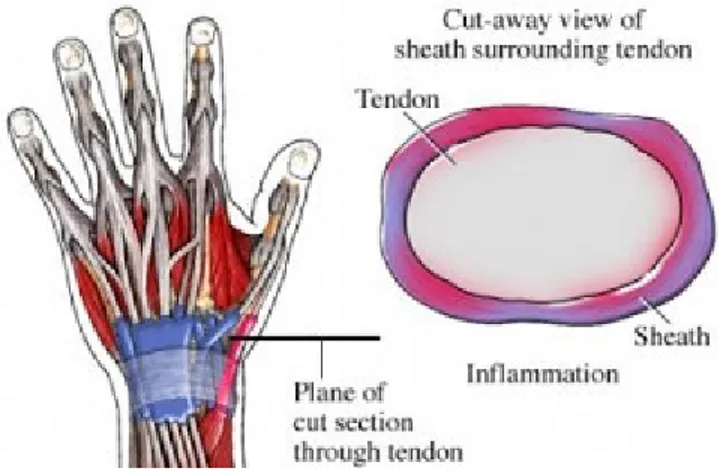 Gambar 5. Retinakulum otot-otot ekstensor, tendon sheath, dan potongan  transversal tendon sheath