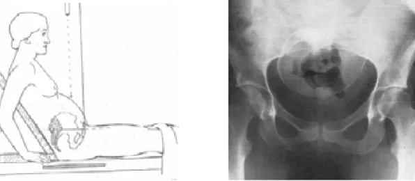 Gambar 7. Posisi Thoms dan hasil pemeriksaan X-ray pelvimetri (dikutip dari bahan 22) 