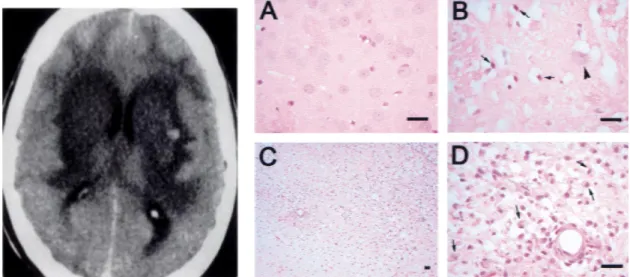 Gambar 3. CT scan otak intoksikasi metanol akut (kiri) dan nekrosis neuron pada  striatum dengan pengecatan HE 9  (kanan) dengan keterangan : Normal neuron  pada striatum (caudate-putamen) (A), serangan akut pada neuron dimana terjadi 