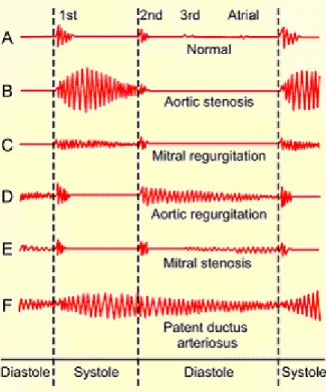 Gambar 2. Ragam gelombang suara jantung normal dan abnormal  