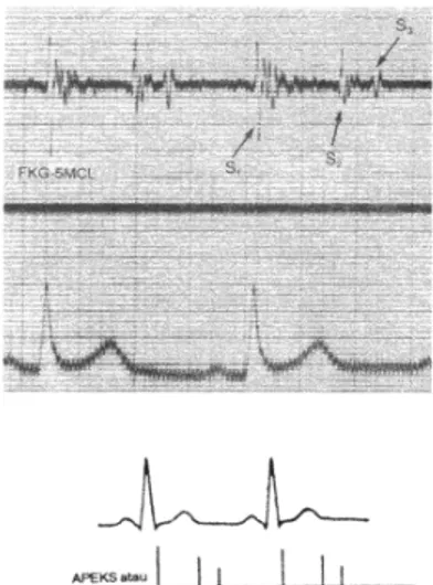 Gambar 1. Munculnya suara jantung S1, S2, dan S3 pada jantung no