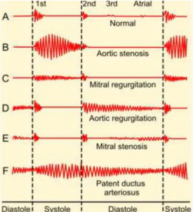 Gambar 2.4. Ragam gelombang suara jantung normal dan abnormal (Puspasari dkk, 2012)