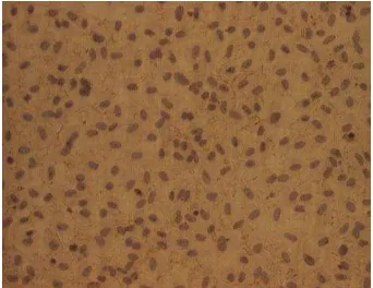 Figure 2. The positive expression of von Willebrand factor (vWF) in endothelial cells