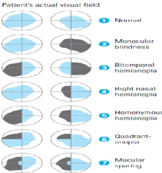 Gambar 6. Defek visual sesuai dengan kerusakan pada  level yang berbeda dari system visual (sesuai dengan 