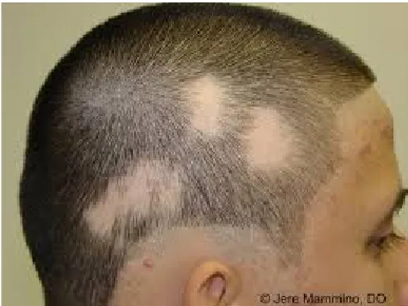 Fig. 1.1 Foto alopecia areata. Rambut hilang total dibeberapa area di kepala.