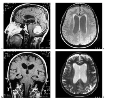 Gambar 12a &amp; b. MRI potongan axial pada hidrosefalus nonkomunikans akibat  obstruksi pada foramen Luschka dan magendie