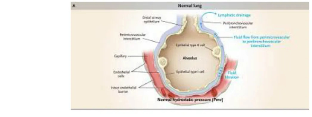 Gambar 3. Paru Normal (dikutip dari Lorraine et al, 2005)  Terdapat dua mekanisme terjadinya edema paru: 