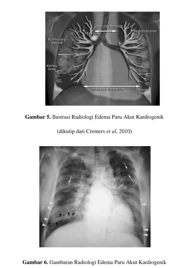 Gambar 5. Ilustrasi Radiologi Edema Paru Akut Kardiogenik  (dikutip dari Cremers et al, 2010) 