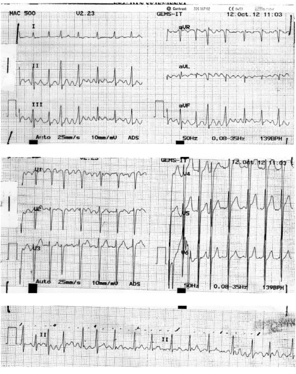 Gambar 3.1. Hasil EKG 12 Oktober 2012