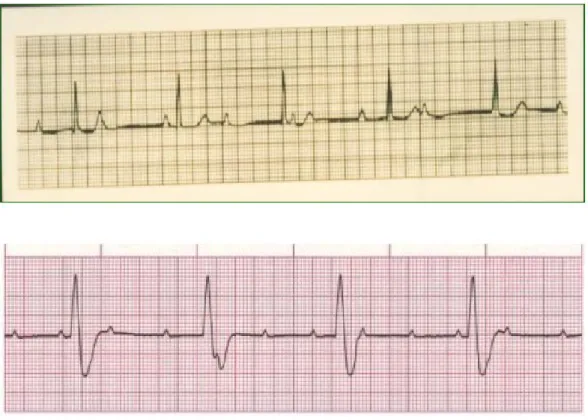 Gambar 5. Gambaran EKG pada AV block derajat III. 