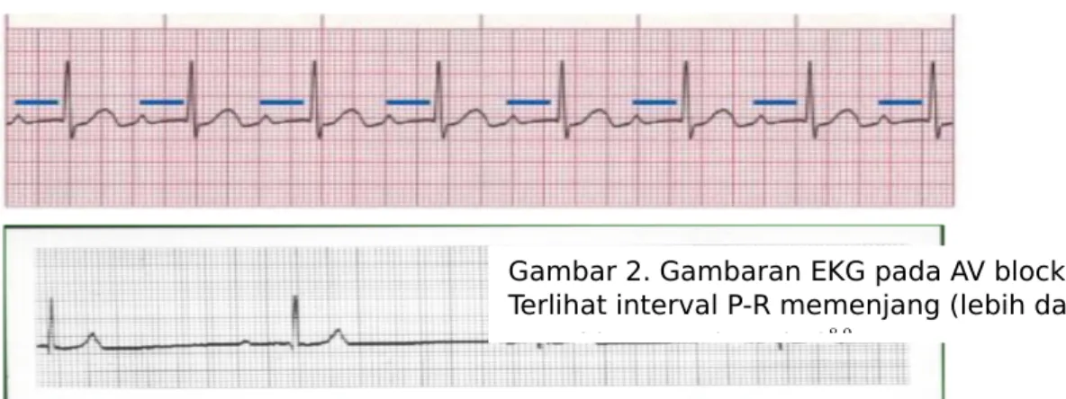 Gambar 2. Gambaran EKG pada AV block derajat I. 