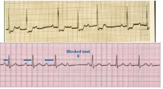 Gambar 3. Gambaran EKG pada AV block derajat II  Tipe 1 dimana P-R inrterval semakin lama semakin  memanjang, serta terdapat satu gelombang P yang  tidak diikuti kompleks QRS (pada gambar)