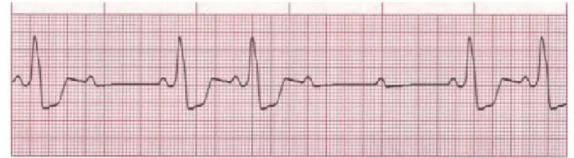 Gambar 4. Gambaran EKG pada AV block derajat II tipe 2 terlihat adanya gelombang P yang tidak diikutu  kompleks QRS serta pelebaran kompleks QRS