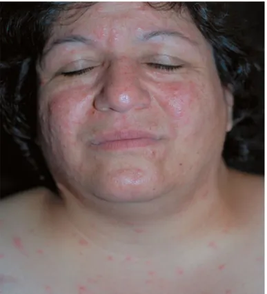Gambar 5.2 Gambaran orang yang terkena infeksi varicella Sumber : http://www.emedicinehealth.com