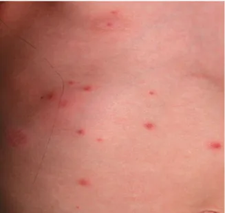 Gambar 5.3 Infeksi varicella pada penderita dengan imunisasi Sumber : http://www.emedicinehealth.com