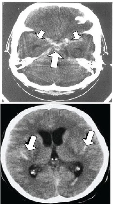 Gambar 7: CT scan kepala di mana terdapat gambaran  hiperdens dalam cisterna suprasellar (anak  panah besar) dan dalam fissura Sylvian (anak panah kecil) yang menunjukkan perdarahan 