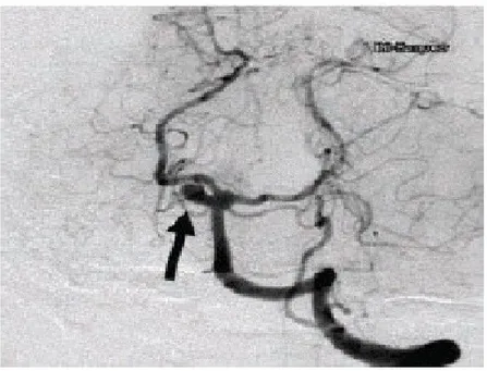 Gambar 9: gambaran angiografi sirkulasi posterior menunjukkan gambaran aneurisma  (anak  panah), terletak di antara Arteri Basilaris dan Arteri Serebri Posterior.