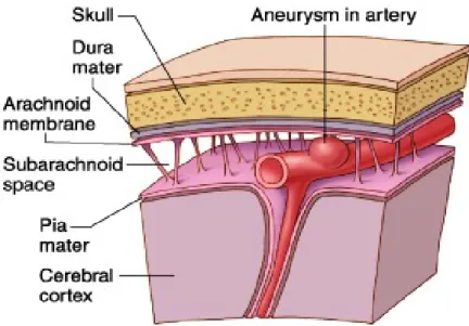 Gambar 5: Aneurisma pada arteri cerebri