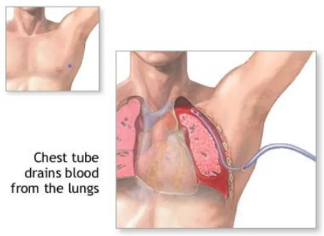 Gambar pemasangan chest tube