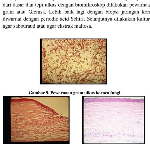 Gambar 9. Pewarnaan gram ulkus kornea fungi 