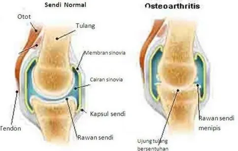 Gambar 3. Anatomi sendi lutut normal dan OA 6