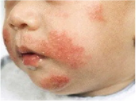 Gambar 3 : Dermatitis atopi pada bayi pada wajah akibat alergi protein. 6