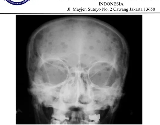 Gambar  2. Foto  os. cranium  yang menggambarkan sejumlah lesi litik dengan raindrop