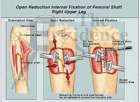 Gambar 2.5. Open Reduction Internal Fixation of Femoral Shaft 