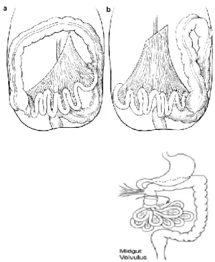 Gambar 1. a. Mesentrika usus normal, b.Malrotasi  usus dan volvulus midgut
