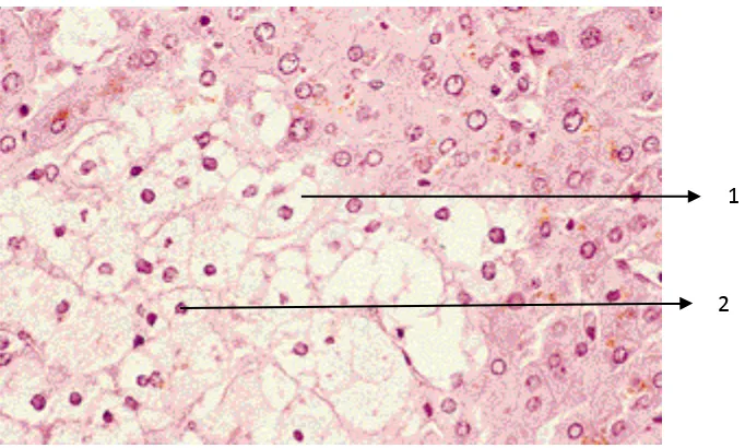 Gambar 10.  Pembengkakan sel disertai vakuolisasi; Ket.: 1. Sel yang mengalami vakuolisasi, 2