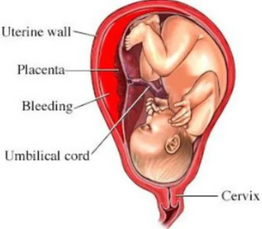 Gambar 2. 1 Solusio Plasenta (Placental abruption) (10).
