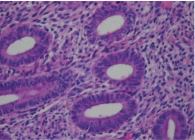 Gambar 2.1 Simple hyperplasia tanpa atypia