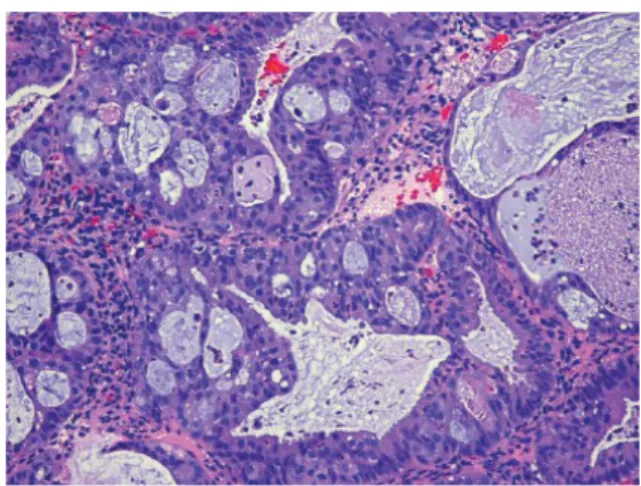 Gambar 2.4  Complex atypical hyperplasia