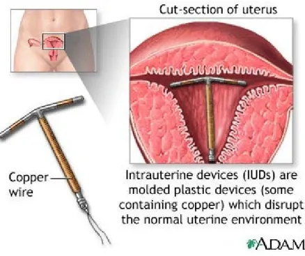 Gambar 1. IUD tembaga 8